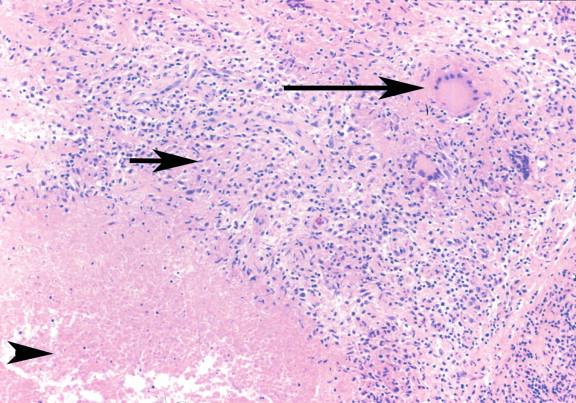 Figure 20-7, This necrotizing granuloma from a patient with tuberculosis demonstrates caseous necrosis (arrowhead), activated epithelioid histiocytes (short arrow), and multinucleate giant cells (long arrow). H&E stain, 100 × magnification.