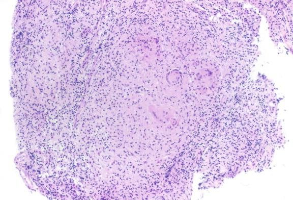 Figure 20-8, This non-necrotizing granuloma is from the same patient with tuberculosis as in Figure 20-7 , demonstrating that both necrotizing and non-necrotizing granulomas may be seen in tuberculosis. H&E stain, 100 × magnification.