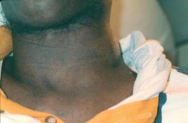 Figure 20-10, This patient with advanced HIV infection (i.e., AIDS) has lymph nodes that are essentially replaced by fibrous pseudotumor generated by fibrous tissue, which is the only reaction he could mount against M. tuberculosis.