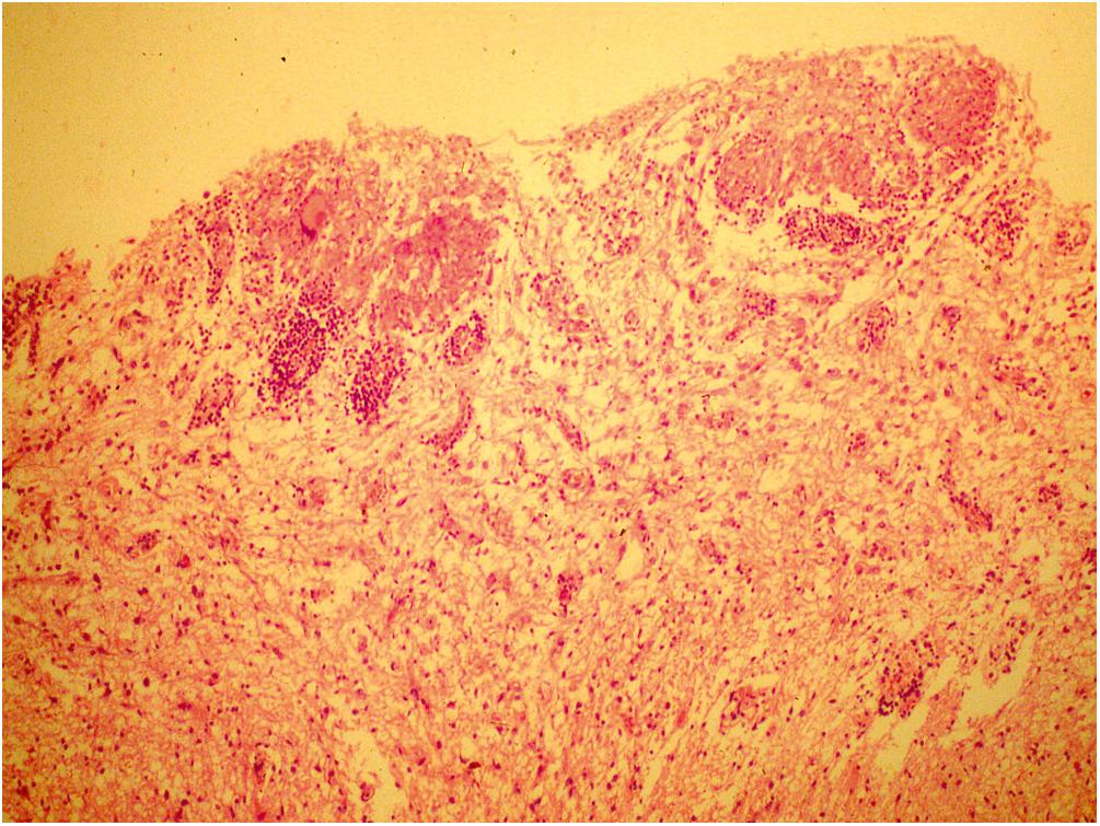 Figure 40-1, Section from an autopsied case of tuberculous meningitis showing fresh granulomas beneath the surface of the brain, having eroded through the pia membrane into the subarachnoid space. (Hematoxylin and eosin, ×400.)