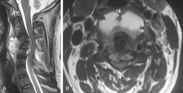 FIGURE 26-3, In the subaxial cervical spine, neural compression is early because of the limited space available for the spinal cord at this level. Sagittal ( A ) and axial ( B ) T2-weighted magnetic resonance images in a case of C4 tuberculosis with myelopathy. The compression results from a combination of abscess, sequestrated fragments, granulation tissue, and retropulsion of the diseased vertebra.