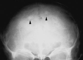 FIGURE 88-1, Anteroposterior view of the skull demonstrates focal areas of sclerosis (arrowheads) .