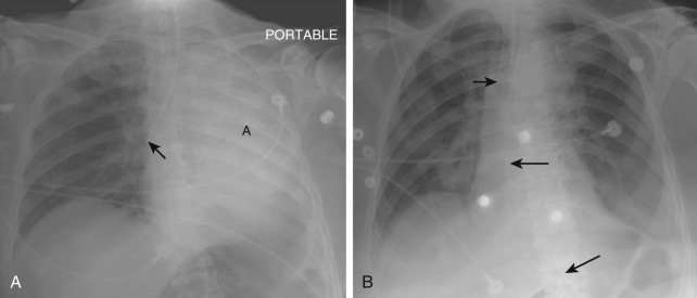 Figure 22-1, A, Malpositioned ETT on frontal chest radiograph. Note tip of ETT within proximal right mainstem bronchus ( arrow ) with complete atelectasis ( A ) of left lung. B, Repositioning of ETT on frontal chest radiograph. Note tip of ETT ( arrow ) now appropriately positioned within distal trachea with resolution of previously noted left lung atelectasis. Also note the normal course of newly placed NGT ( long arrows ), which follows expected course of esophagus before entering abdomen.