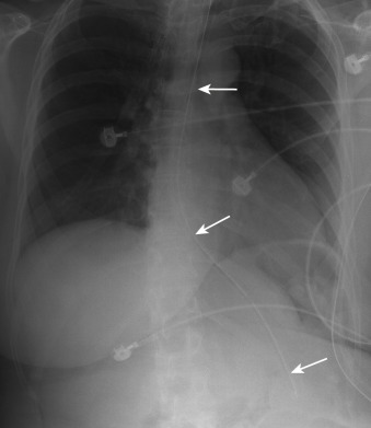 Figure 22-2, Appropriately positioned NGT on frontal radiograph. Note thin radiopaque curvilinear strip along entire length of NGT ( arrows ), which extends inferiorly along midline of chest in expected location of esophagus with tip overlying expected location of stomach.