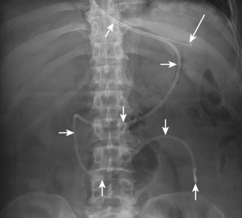 Figure 22-3, Appropriately positioned feeding tube on frontal abdominal radiograph. Note feeding tube ( short arrows ) that curves to follow C-shaped loop of duodenum with radiopaque marker at tip overlying expected located of duodenojejunal junction (ligament of Treitz). Also note appropriately positioned tip of NGT ( long arrow ) overlying expected location of stomach in left upper quadrant of abdomen with thin radiopaque curvilinear strip along its visualized portion.