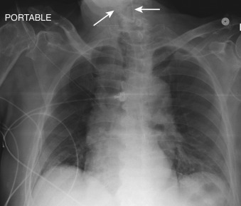 Figure 22-4, Malpositioned feeding tube on frontal chest radiograph. Note portion of feeding tube ( arrows ) curled within pharynx and upper thoracic esophagus.