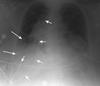 Figure 22-5, Malpositioned feeding tube on frontal chest radiograph. Note feeding tube ( short arrows ) following course of right bronchi and terminating in inferior right hemithorax within pleural space. Also note right thoracostomy tube ( long arrows ) within right pleural space to drain complex pleural fluid.