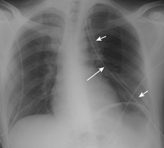 Figure 22-6, Appropriately positioned thoracostomy tube for pneumothorax on frontal chest radiograph. Note gentle curve of thoracostomy tube ( short arrows ) with curvilinear radiopaque stripe and short-segment interruption because of side hole ( long arrow ) with tip located near lung apex directed anterosuperiorly.