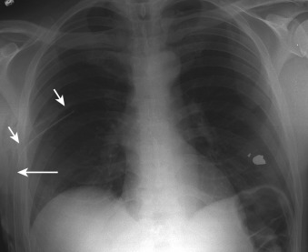 Figure 22-7, Malpositioned thoracostomy tube on frontal chest radiograph. Note thoracostomy tube ( short arrow ) with side hole ( long arrow ) located external to rib cage.