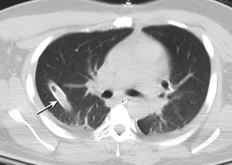 Figure 22-8, Malpositioned thoracostomy tube on CT. Note thoracostomy tube ( arrow ) located within right lung parenchyma instead of pleural space.