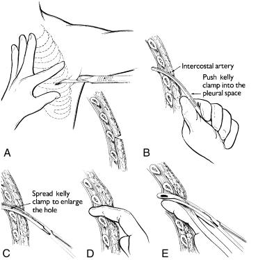 Fig. 31.2, Thoracostomy tube placement.