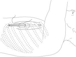 Fig. 31.3, Purse-string ligature around chest tube site.