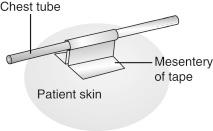 Fig. 31.4, Tape mesentery technique for securing chest tubes.