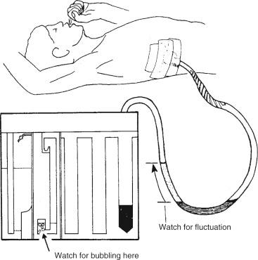 Fig. 31.5, Loss of fluctuation of the underwater seal. Ask the patient to cough, and observe for any fluctuation or bubbling.