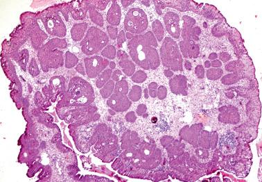 Fig. 4.1, Florid squamous metaplasia in a cervical polyp.