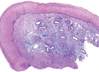 Fig. 4.11, Endometriosis. The hyperchromatic appearance of the glands and endometrial stroma are both conspicuous.