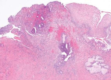 Fig. 4.12, Endometriosis. Two foci of endometriosis contrast with normal endocervical glands (right). Note the surrounding cellular stroma and hemorrhage.