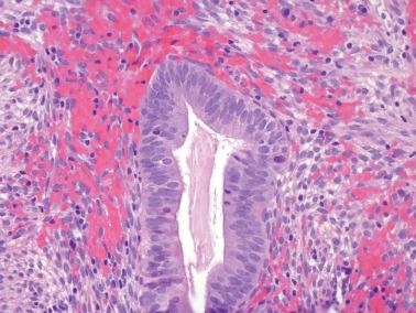 Fig. 4.14, Endometriosis. High-power view showing hyperchromatic mucin-poor cells with sporadic mitotic figures, potentially causing confusion with glandular neoplasia. Note the helpful finding of endometrial-type stroma with hemorrhage.