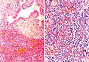 Fig. 4.15, Stromal endometriosis of endocervix at low- and high-power magnifications. Note hemorrhage between the endometriotic stromal cells. The appearance could suggest a diagnosis of Kaposi's sarcoma.