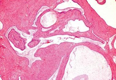 Fig. 4.17, Endocervicosis. Endocervical-type glands with an irregular size and shape lie within the outer wall of the cervix.