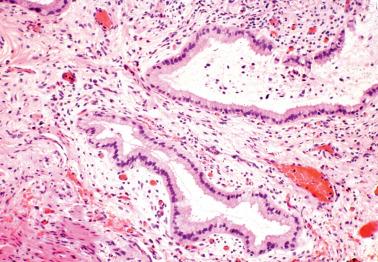 Fig. 4.18, Endocervicosis. Endocervical-type glands are surrounded by a reactive stroma, an appearance that initially raised concern for minimal-deviation adenocarcinoma (adenoma malignum).