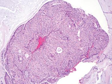 Fig. 4.2, Florid squamous metaplasia in an endocervical curettage. Occasional residual gland lumens are seen.