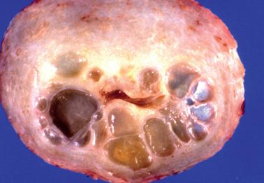 Fig. 4.21, Deep Nabothian cysts.