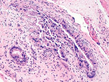 Fig. 4.23, Atypical oxyphilic metaplasia. Several glands are lined by cells with conspicuous eosinophilic cytoplasm and hyperchromatic nuclei.
