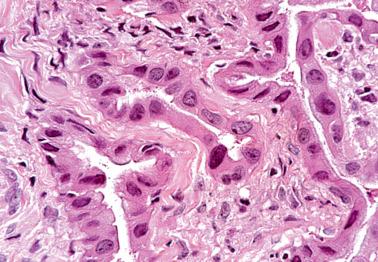 Fig. 4.24, Atypical oxyphilic metaplasia. High power of another case shows variation in nuclear size and shape.