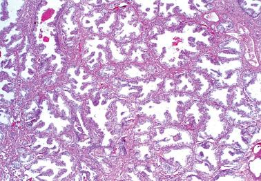 Fig. 4.25, Ectopic prostatic tissue.