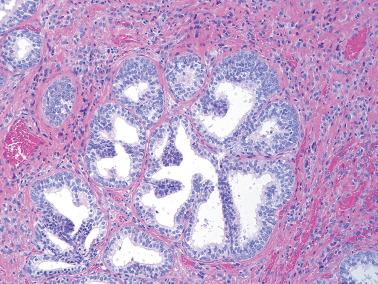 Fig. 4.26, Ectopic prostatic tissue. Secretory and basal type cells are clearly seen.