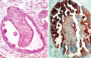 Fig. 4.28, Ectopic prostatic tissue. Gland with squamous metaplasia (left). The gland is immunoreactive for prostate-specific antigen (right).