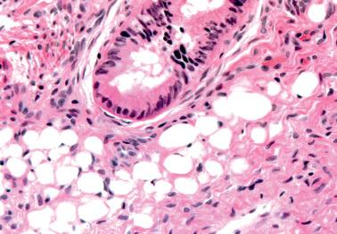 Fig. 4.29, Fat within endocervical stroma (see text).