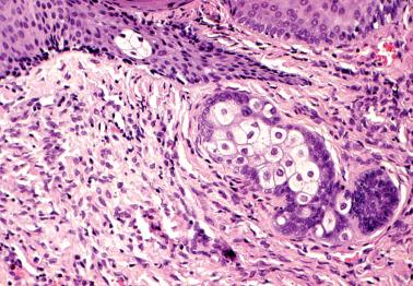 Fig. 4.30, Ectopic sebaceous glands within the endocervical stroma.