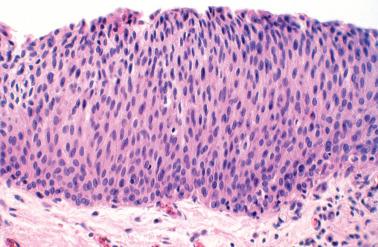 Fig. 4.3, Transitional cell metaplasia. The monotonous full-thickness abnormality may suggest a high-grade intraepithelial lesion. Even at this magnification a lack of mitotic activity can be appreciated.