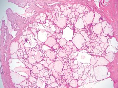 Fig. 4.31, Tunnel cluster, cystic (type B). Abundant luminal mucin devoid of appreciable numbers of inflammatory cells is typically seen within the cystic glands.