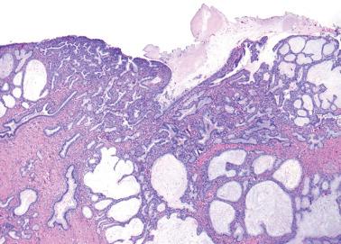 Fig. 4.34, Tunnel clusters, noncystic and cystic (types A and B). In some cases, the cystic (bottom) and noncystic (top) glands are less well circumscribed than is typical and form a striking low-power appearance.