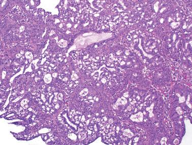 Fig. 4.35, Microglandular hyperplasia. Typical variably sized glands with inspissated mucin containing inflammatory cells. Abundant subnuclear vacuoles are conspicuous.