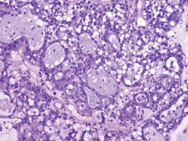 Fig. 4.37, Microglandular hyperplasia. Typical glands with mucin are separated by a solid proliferation of vacuolated cells.