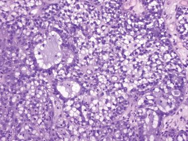 Fig. 4.38, Microglandular hyperplasia. Conspicuous vacuolated cells, many having a signet- ring configuration, form a focally solid pattern.