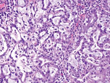 Fig. 4.39, Micrograndular hyperplasia. Irregular glands have fused and produced a reticular pattern. Focal mild cytologic atypia is present.