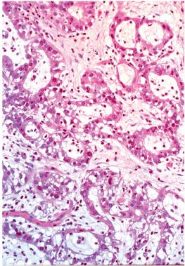 Fig. 4.40, Microglandular hyperplasia. A reactive-appearing myxoid stroma is present in this case.