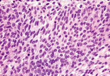 Fig. 4.4, Transitional cell metaplasia. The nuclei are elongated and appear to be ‘streaming’. Some nuclei have grooves.