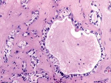 Fig. 4.41, Microglandular hyperplasia. Prominent stromal hyalinization is seen in some cases. Note subtle subnuclear clearing, a clue to the diagnosis.