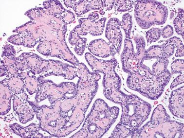 Fig. 4.42, Microglandular hyperplasia admixed with papillary cervicitis.