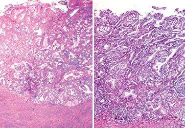 Fig. 4.43, Diffuse laminar endocervical glandular hyperplasia at low (left) and medium (right) magnifications. Note the sharp interface with the subjacent stroma (left) and the chronic inflammatory infiltrate (right).