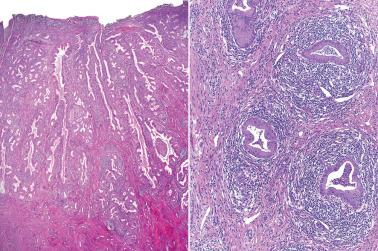 Fig. 4.44, Diffuse laminar endocervical glandular hyperplasia. Note the glandular hyperplasia with well-demarcated interface to the adjacent cervical stroma at the base of the lesion (left). The glands within the proliferation are often surrounded by a mantle of chronic inflammatory cells (right).