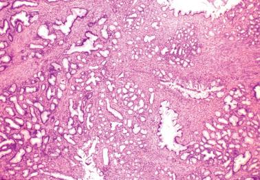 Fig. 4.46, Lobular endocervical glandular hyperplasia.