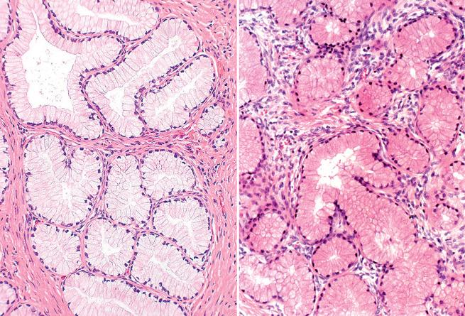Fig. 4.47, Lobular endocervical glandular hyperplasia. The epithelium sometimes has voluminous mucinous cytoplasm (left) whereas in other cases it has a pyloric appearance (right).