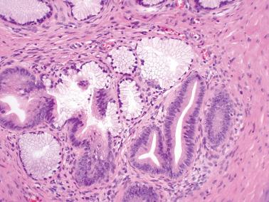 Fig. 4.48, Lobular endocervical glandular hyperplasia with focal glandular dysplasia.
